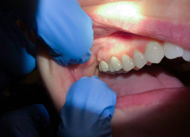 Tooth Infection Emergency Dentist in LA